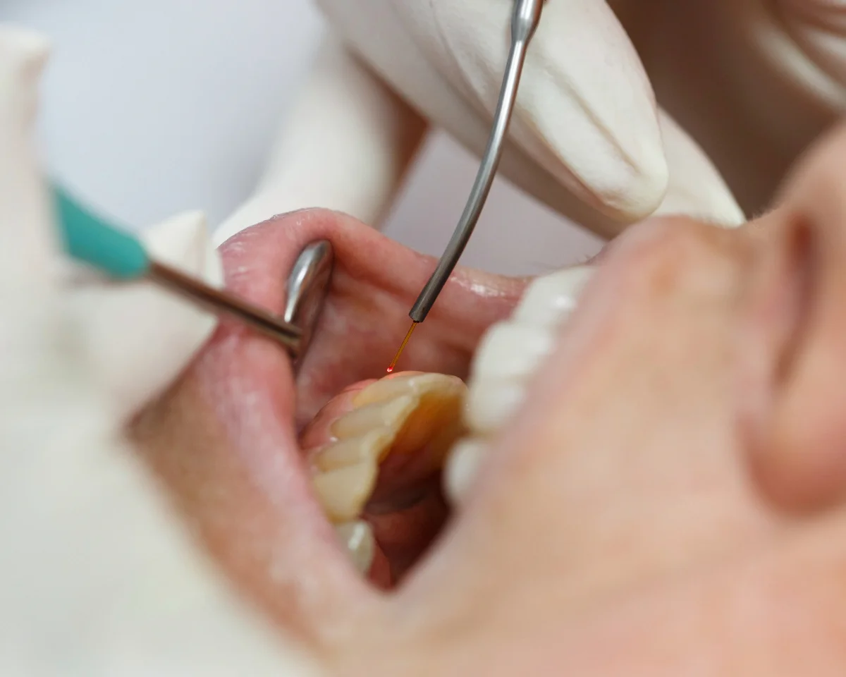 laser use for hygienists